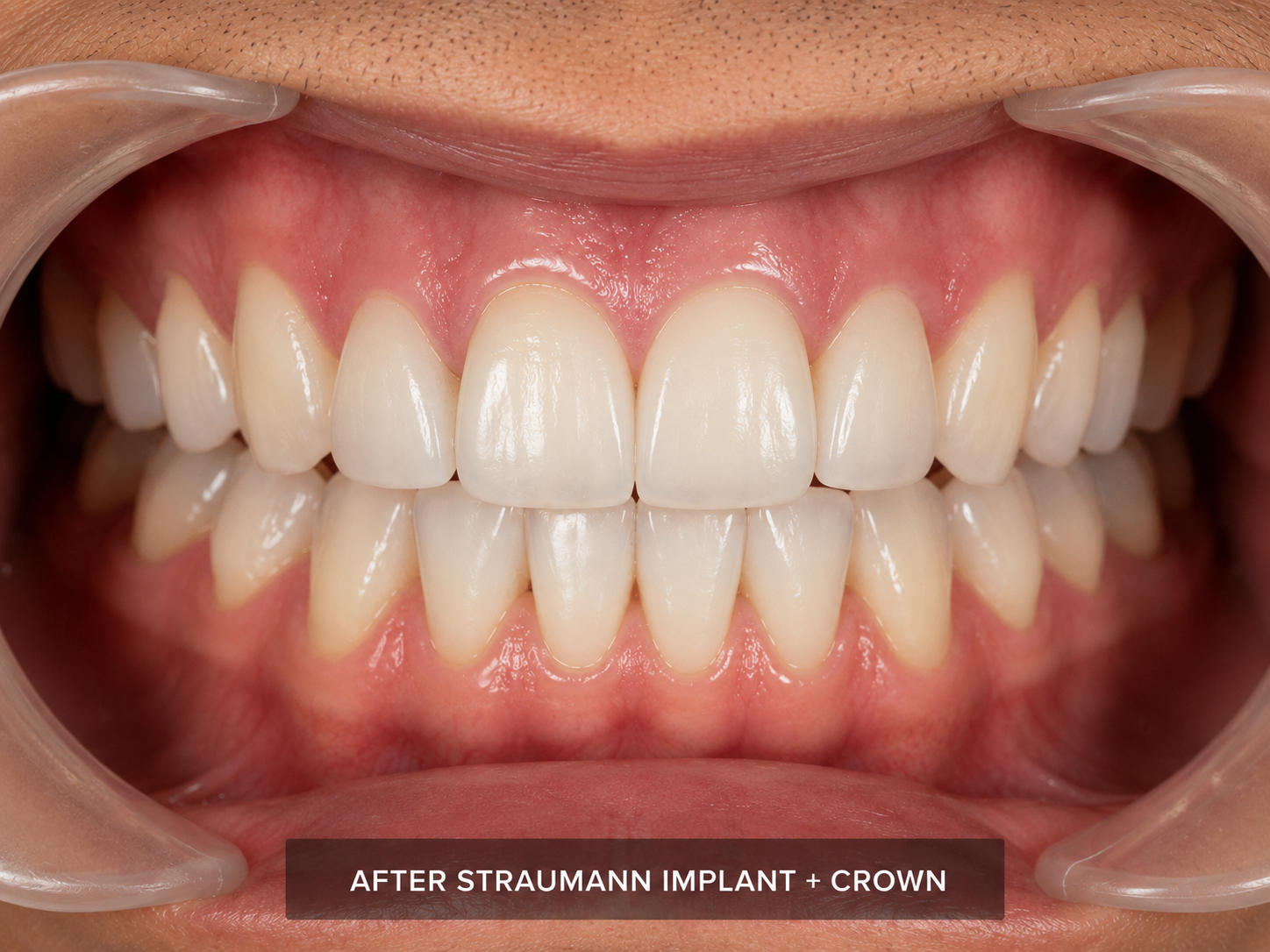After Implant