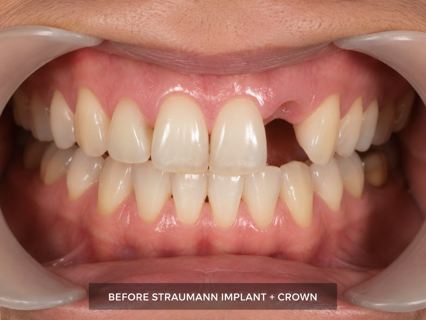 Before Implant