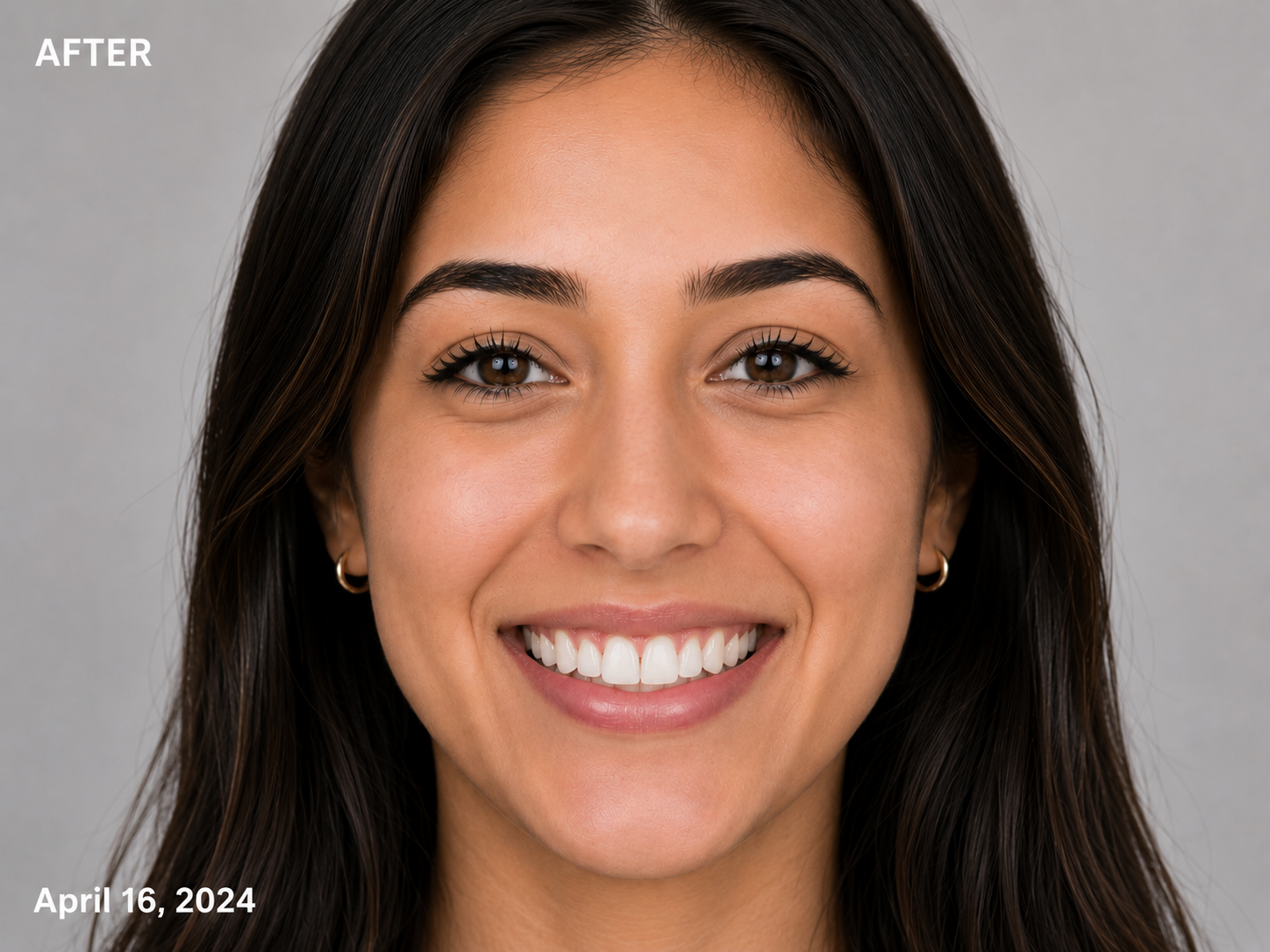 After Veneers