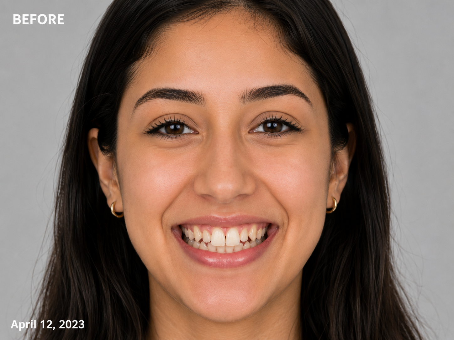Before Veneers