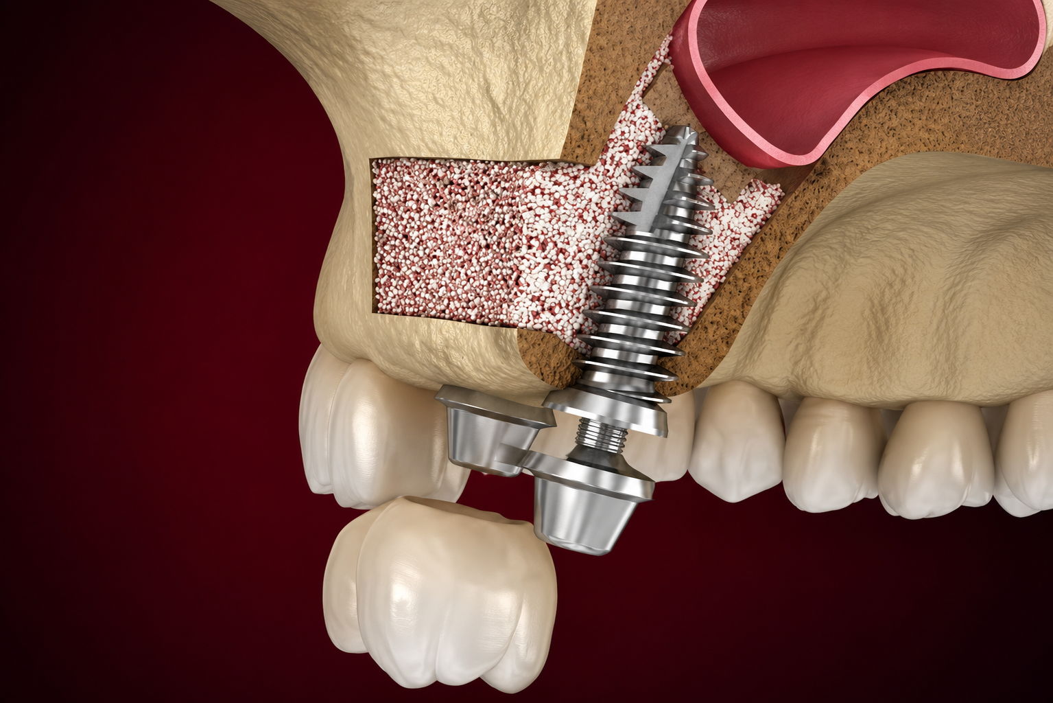 Sinus Lift Procedures